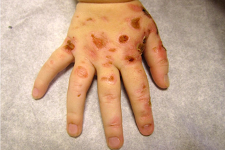 种痘样水疱病手背症状图