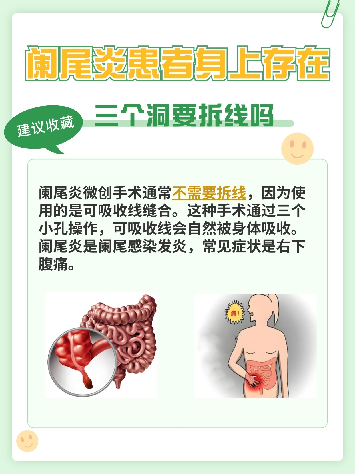 阑尾炎手术三处切口，需要拆线吗？