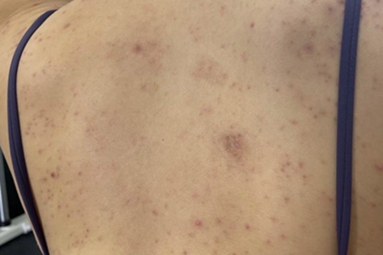 马拉色菌毛囊炎皮肤颜色加深图