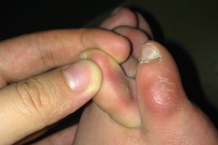 趾间鸡眼图