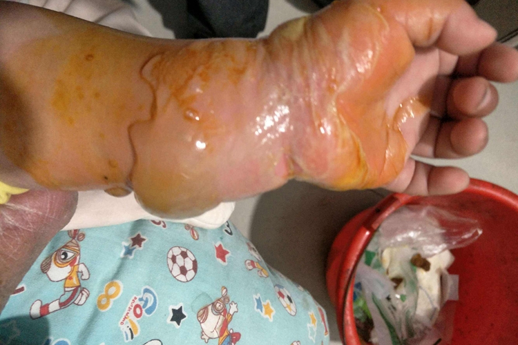 宝宝Ⅱ度烫伤图 宝宝Ⅱ度烫伤图