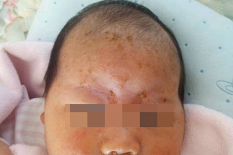 奶癣额头上结很多黄痂图