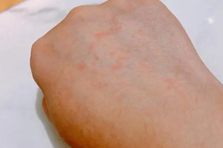 妊娠多形疹症状图 妊娠多形疹症状图