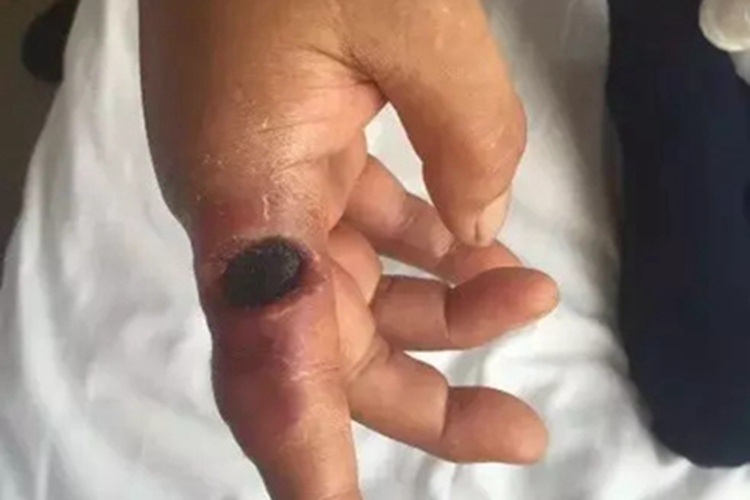 炭疽病手指溃疡图