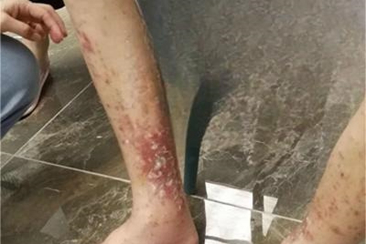 皮肤炭疽红斑图