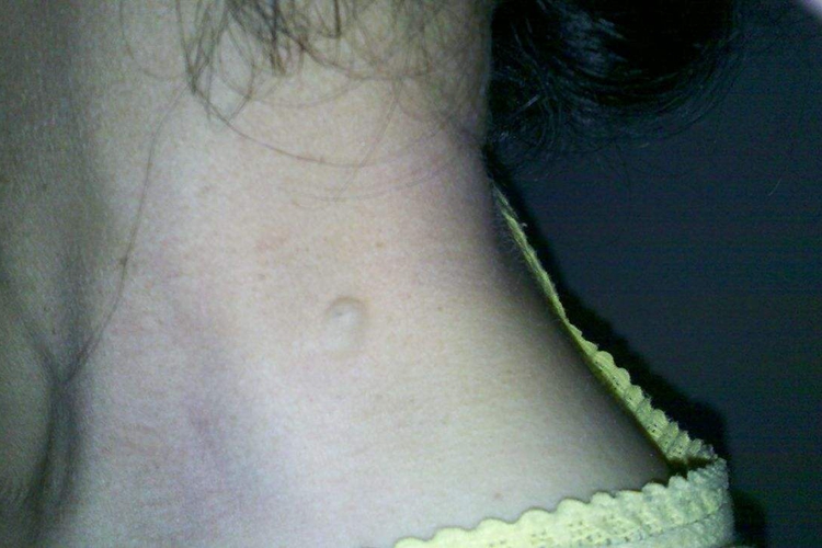 脖子脂肪瘤早期图