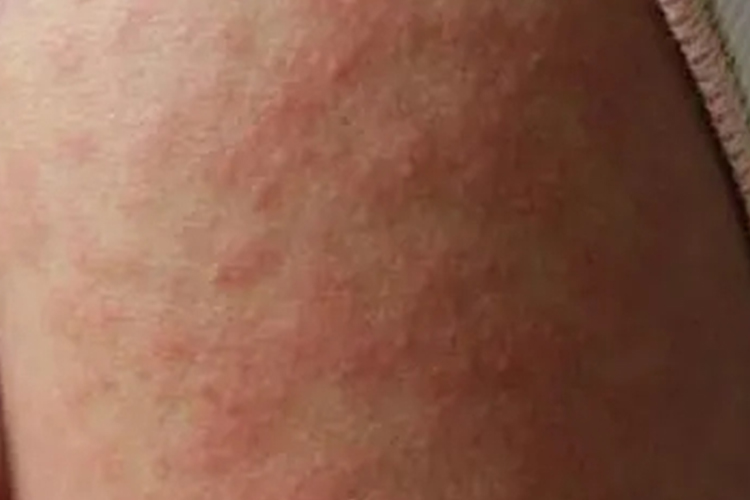 电解液过敏亚急性期丘疹图