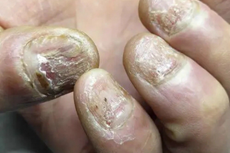甲床炎手指甲脱屑图