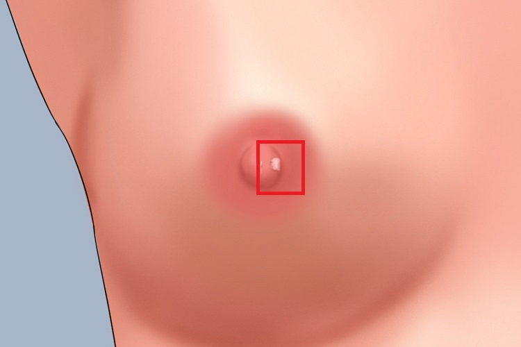 乳头寻常疣图 乳头寻常疣图