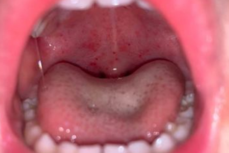 传染性单核细胞增多症性咽峡炎图