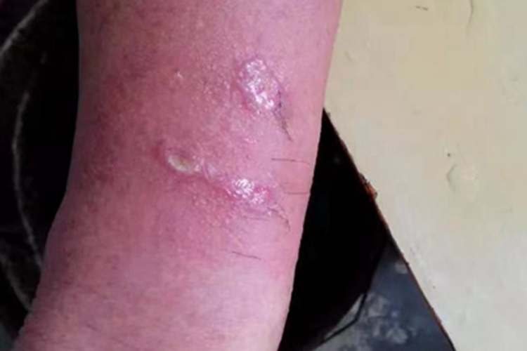 接触性皮炎胳膊症状图