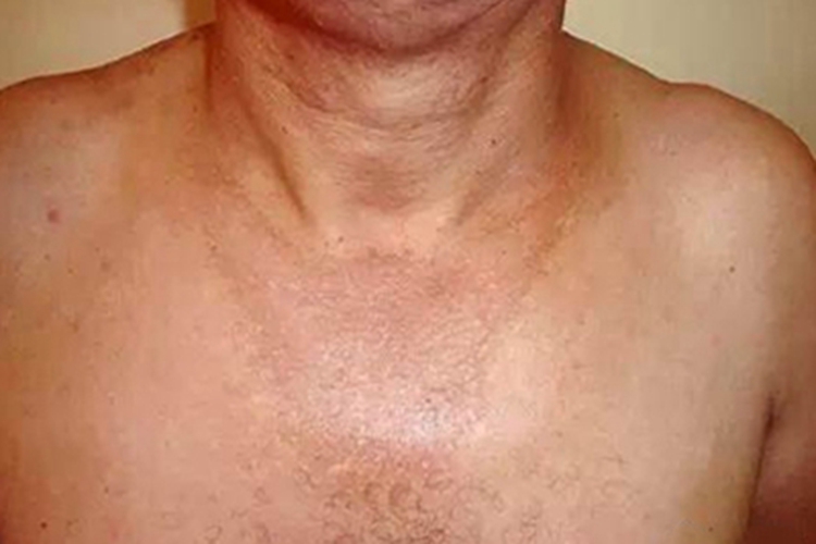 西瓦特皮肤异色病症状图