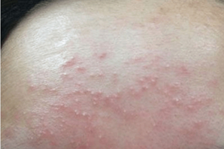 皮肤过敏红肿图 皮肤过敏红肿图