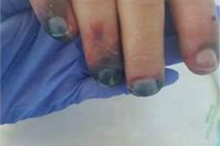 冷凝集素综合征手指甲青紫图 冷凝集素综合征手指甲青紫图