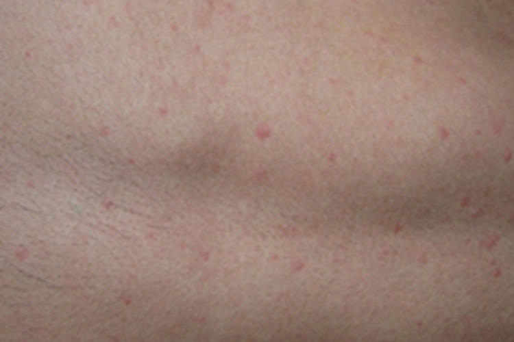 胆碱能性荨麻疹红点图 胆碱能性荨麻疹红点图