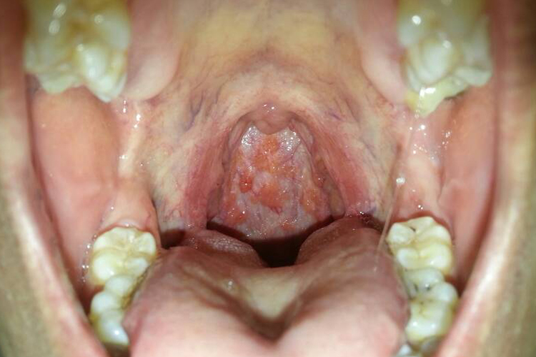 咽后壁淋巴滤泡增生图