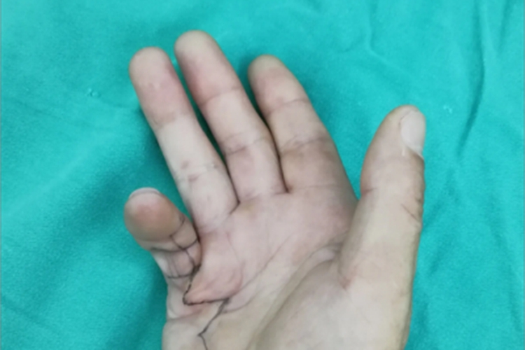 掌腱膜挛缩症手指畸形图