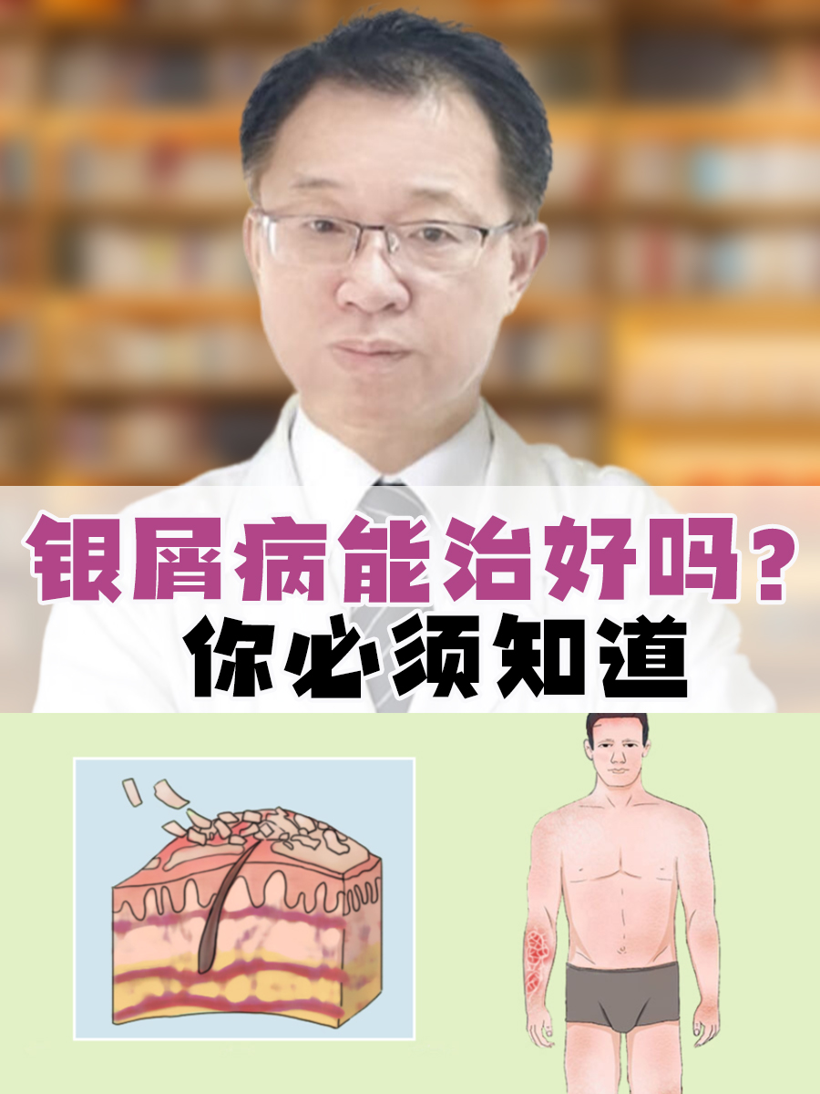 银屑病能治好吗？你必须知道