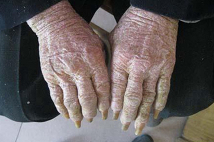 毛发红糠疹性红皮病手背糙脱屑图 毛发红糠疹性红皮病手背糙脱屑图