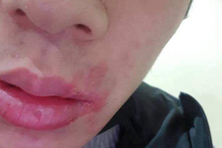 口唇疱疹口周发红起水疱图