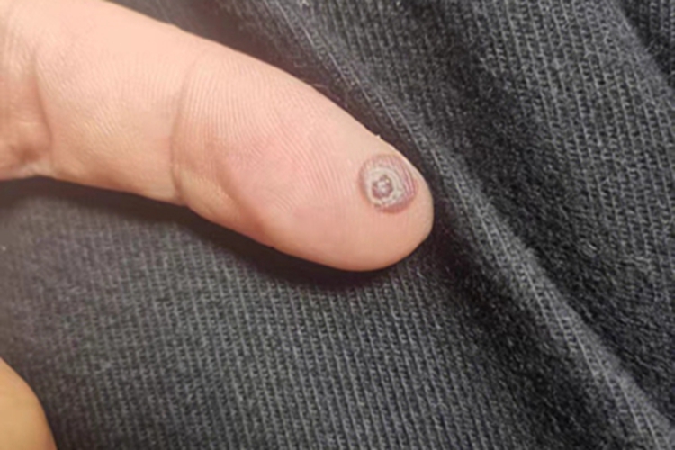 寻常疣手指尖硬疙瘩图 寻常疣手指尖硬疙瘩图