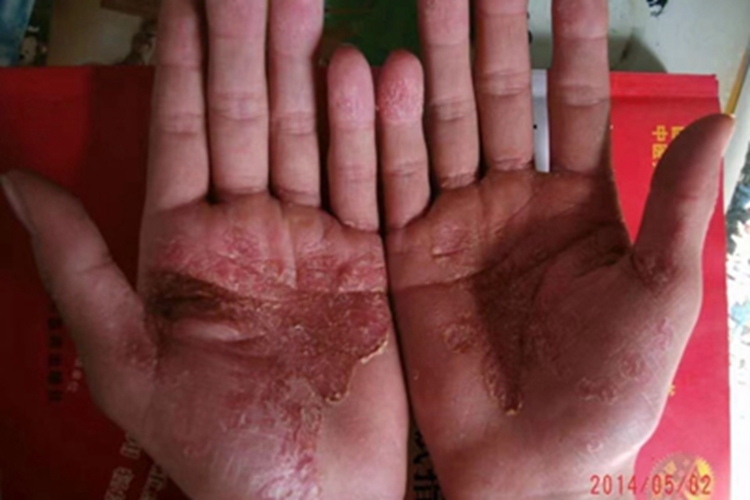 局限性脓疱型银屑病手部脱皮图