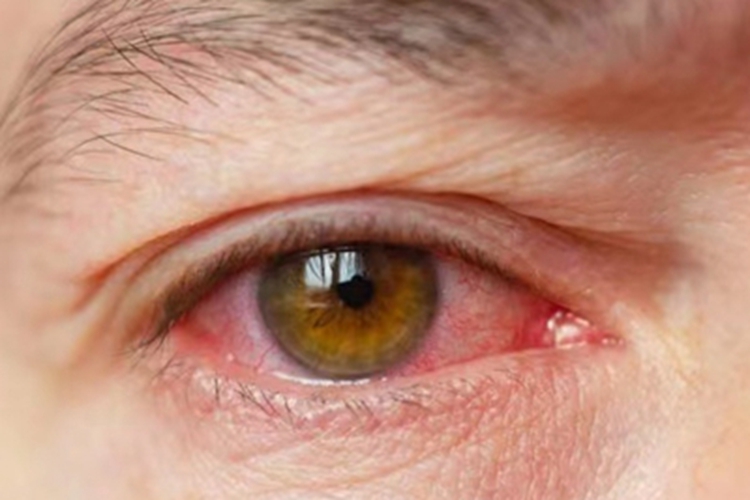 费尔蒂综合征眼球症状图