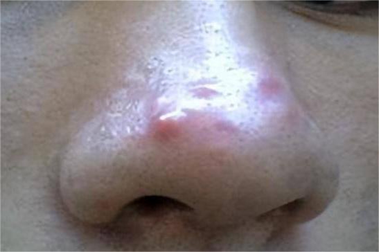 颜面疖痈鼻部症状图 颜面疖痈鼻部症状图