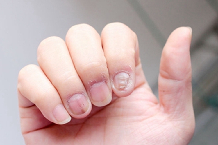 甲萎缩手指甲横纹症状图