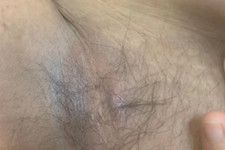 假性黑棘皮病腋下皮肤发黑图