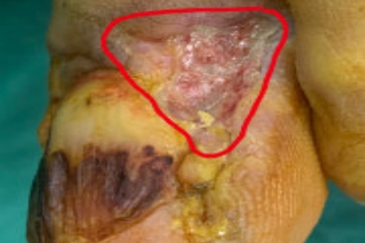 经典型上皮样肉瘤脚趾症状图
