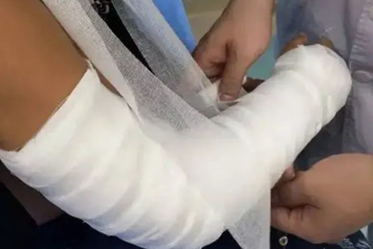 肱骨骨折石膏固定图