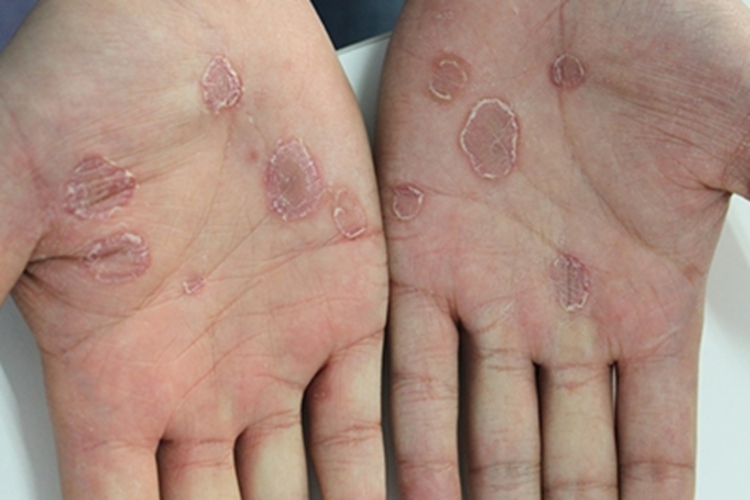 梅毒患者皮肤症状图片图片