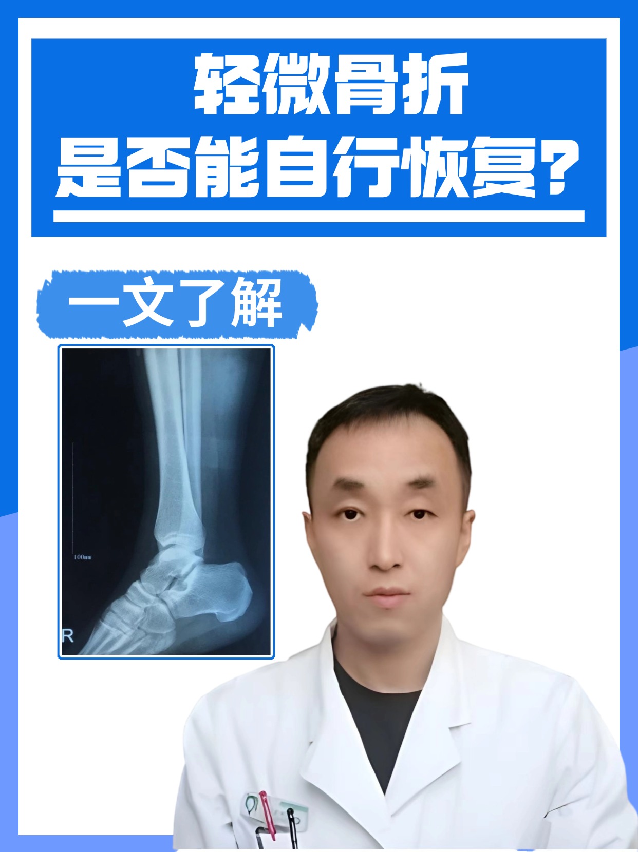 轻微骨折是否能自行恢复？一文了解