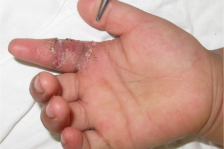 掌腱膜挛缩症手指瘢痕图