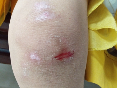 跌伤膝盖外侧皮肤擦伤有小裂口伴脱皮图.jpg