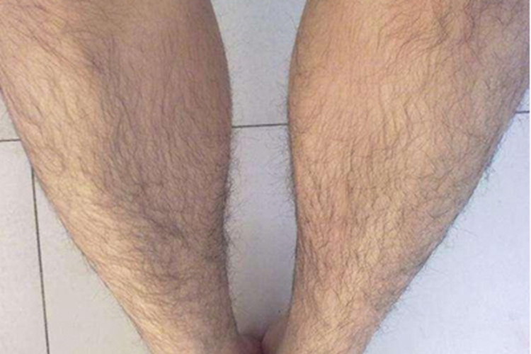 多囊卵巢综合征小腿多毛图