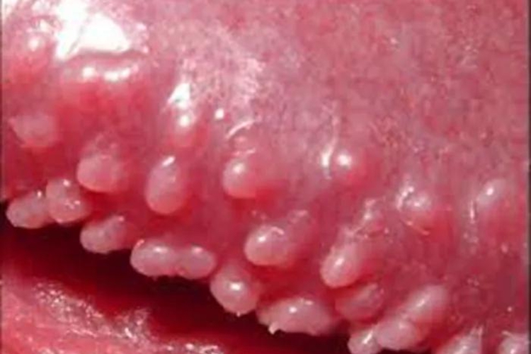 滴虫性包皮龟头炎图