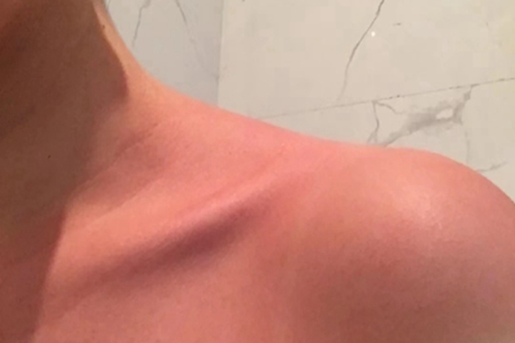日晒伤肩膀通红一大片图 日晒伤肩膀通红一大片图