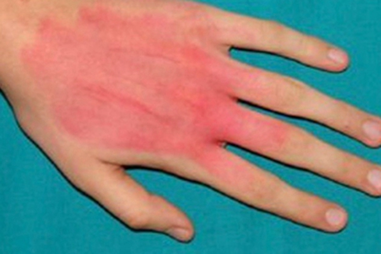 色汗症手背有大片红斑图 色汗症手背有大片红斑图