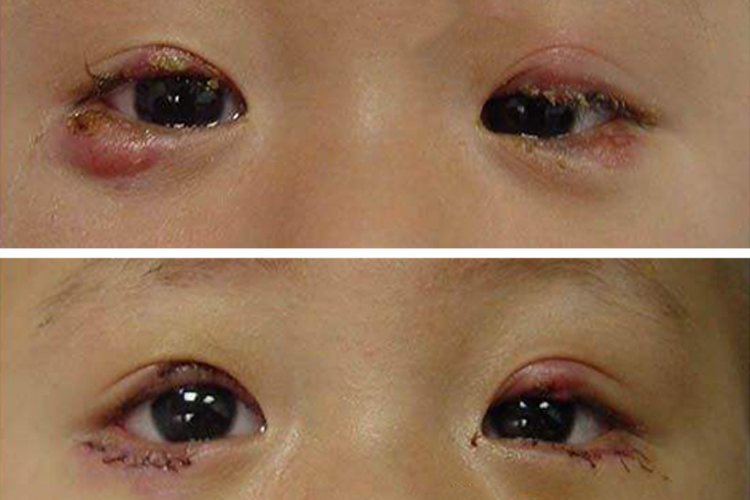 睑板腺囊肿做手术之后图 睑板腺囊肿做手术之后图