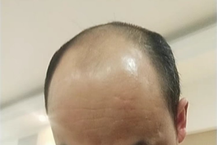 雄激素性脱发头顶秃发图