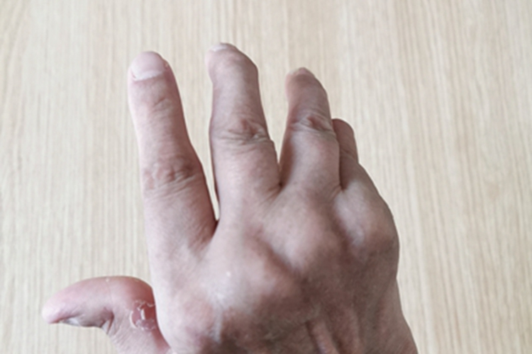 类风湿关节炎手部畸形图