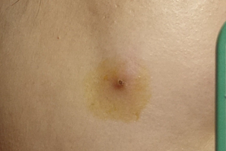 皮脂腺囊肿背部结痂图 皮脂腺囊肿背部结痂图