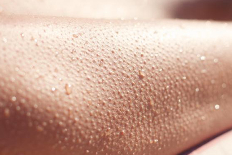 腿部严重毛周角化病图 腿部严重毛周角化病图