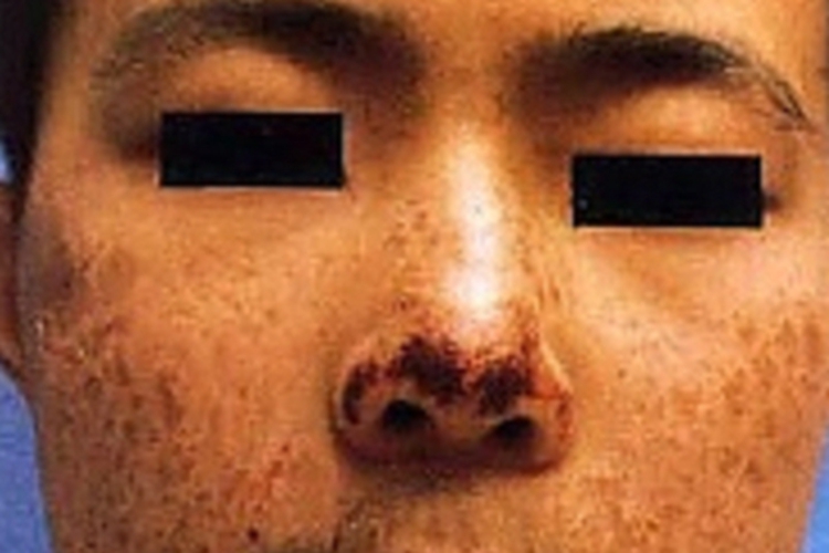 卟啉病面部黑痂图