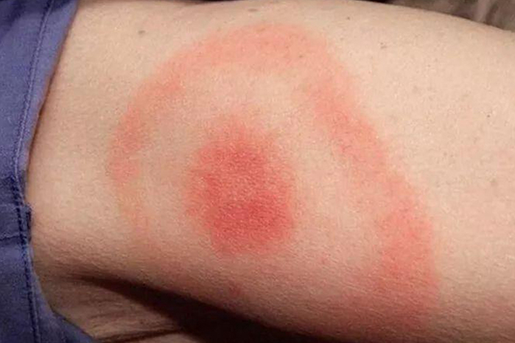 牛眼状游离性红斑