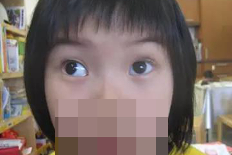 先天性外斜视图