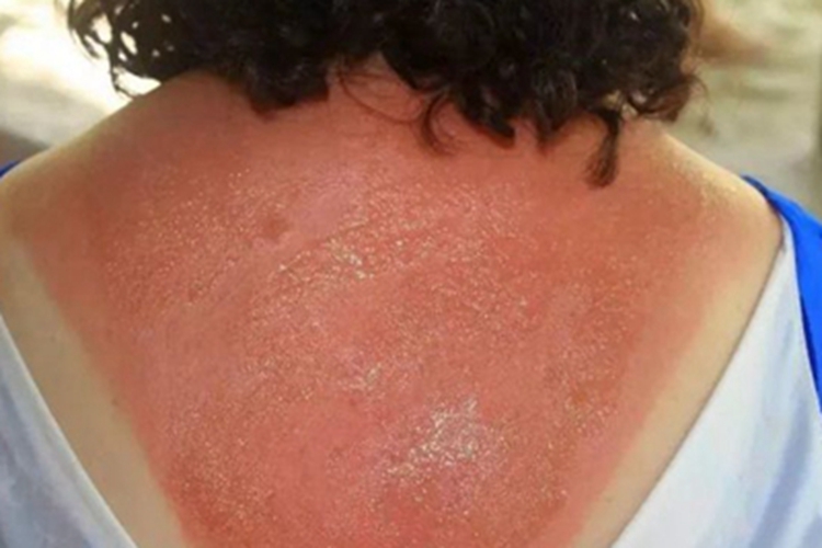 光毒性接触性皮炎背部症状图