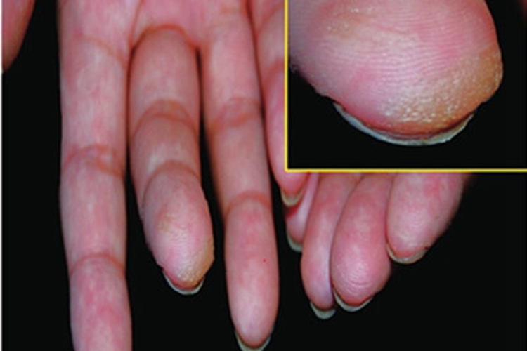 酪氨酸血症Ⅱ型皮肤发黄图